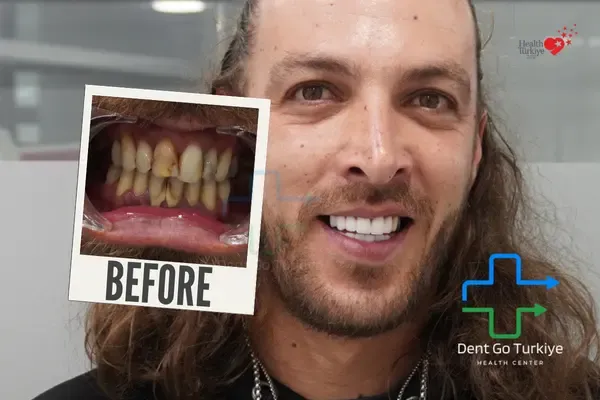 Antes e depois do tratamento dentário