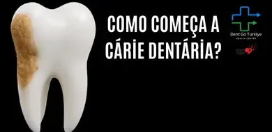 Como Começa a Cárie Dentária? Primeiros Sinais
