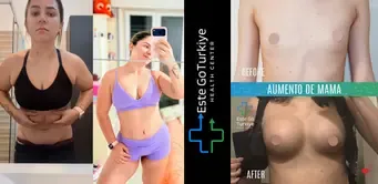 Cirurgia Estética na Turquia:

Rinoplastia, Lipoaspiração, Abdominoplastia e Mommy Makeover