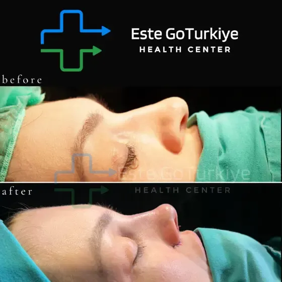 Antes e depois da rinoplastia na Turquia