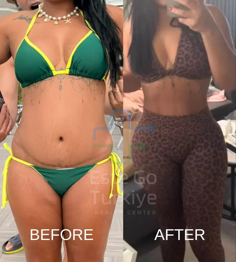 Lipoaspiração Antes e Depois na Turquia: O Que Esperar dos Resultados 