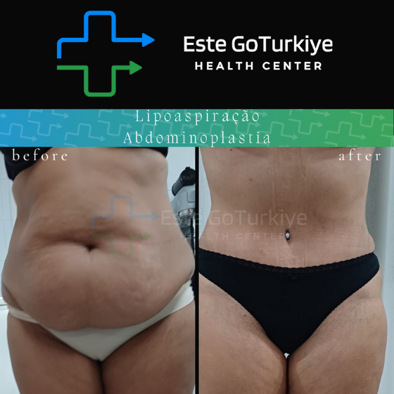 Antes e depois da abdominoplastia na Turquia