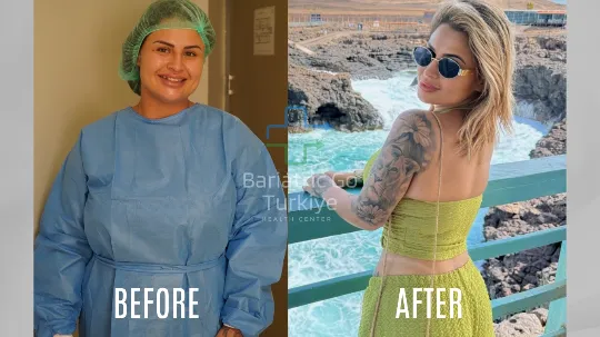 Antes e depois da cirurgia bariátrica