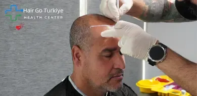 Qual é a Melhor Área Doadora para Transplante Capilar? | Hairgo Clinic