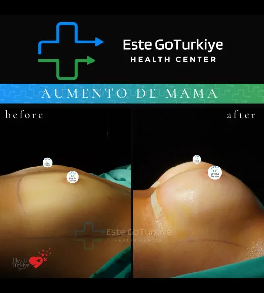 💰 Quanto custa o aumento de mama na Turquia em 2026?