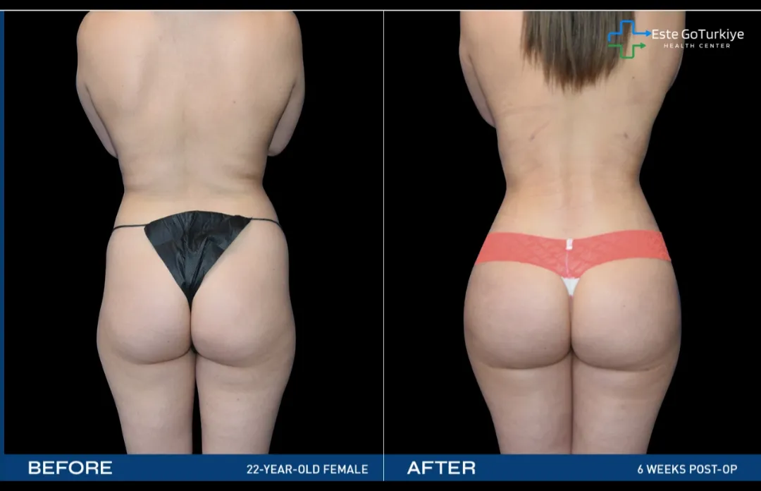 J-Plasma Renuvion: Reafirmação da Pele Segura e Eficaz