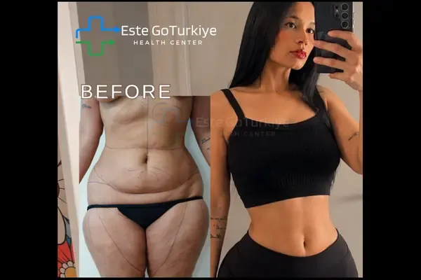 OP. DR. TOLGA - CIRURGIA PLÁSTICA - Antes depois
