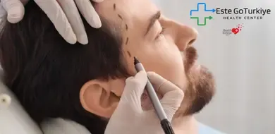Guia de Transplante de Sobrancelha e Barba: Como Garantir uma Aparência Natural na Estética
