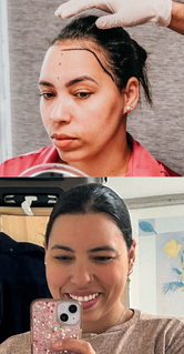 Transplante capilar feminino realizado com técnica especializada para mulheres