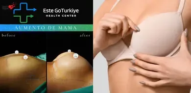 Preço Aumento de Mama na Turquia em 2026: Guia Completo, Custos e Dicas
