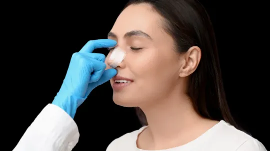 Rinoplastia: foto ilustrativa de rinoplastia com foco no alinhamento do dorso e definição da ponta do nariz.