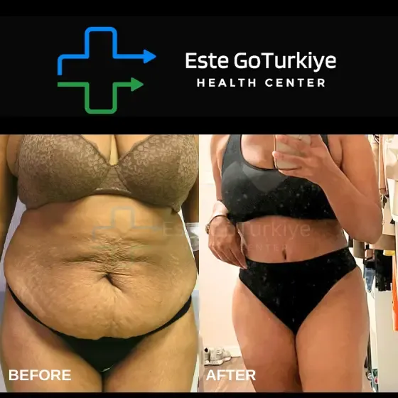 Antes e depois da abdominoplastia na Turquia