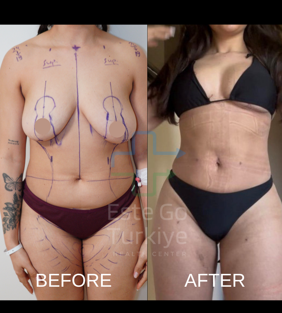 Lipoaspiração Antes e Depois na Turquia: O Que Esperar dos Resultados 
