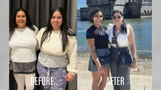 Antes e depois da cirurgia bariátrica