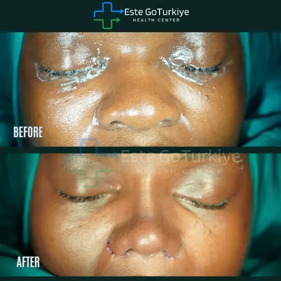 Antes e depois da rinoplastia na Turquia