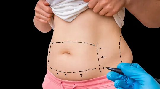 Abdominoplastia: contorno abdominal com cicatriz baixa e umbigo de aspecto natural — imagem ilustrativa.
