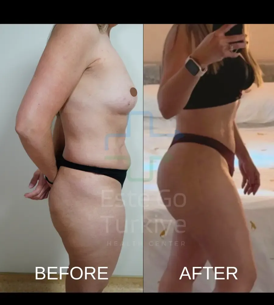 Lipoaspiração Antes e Depois na Turquia: O Que Esperar dos Resultados 